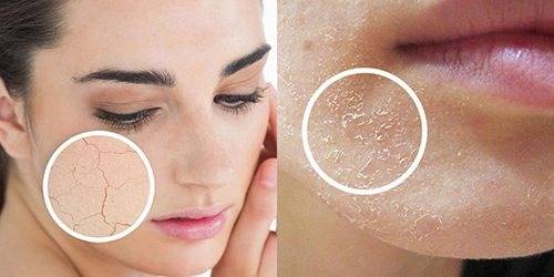 乾燥肌の原因と保湿対策：健康な肌を保つためのポイント
